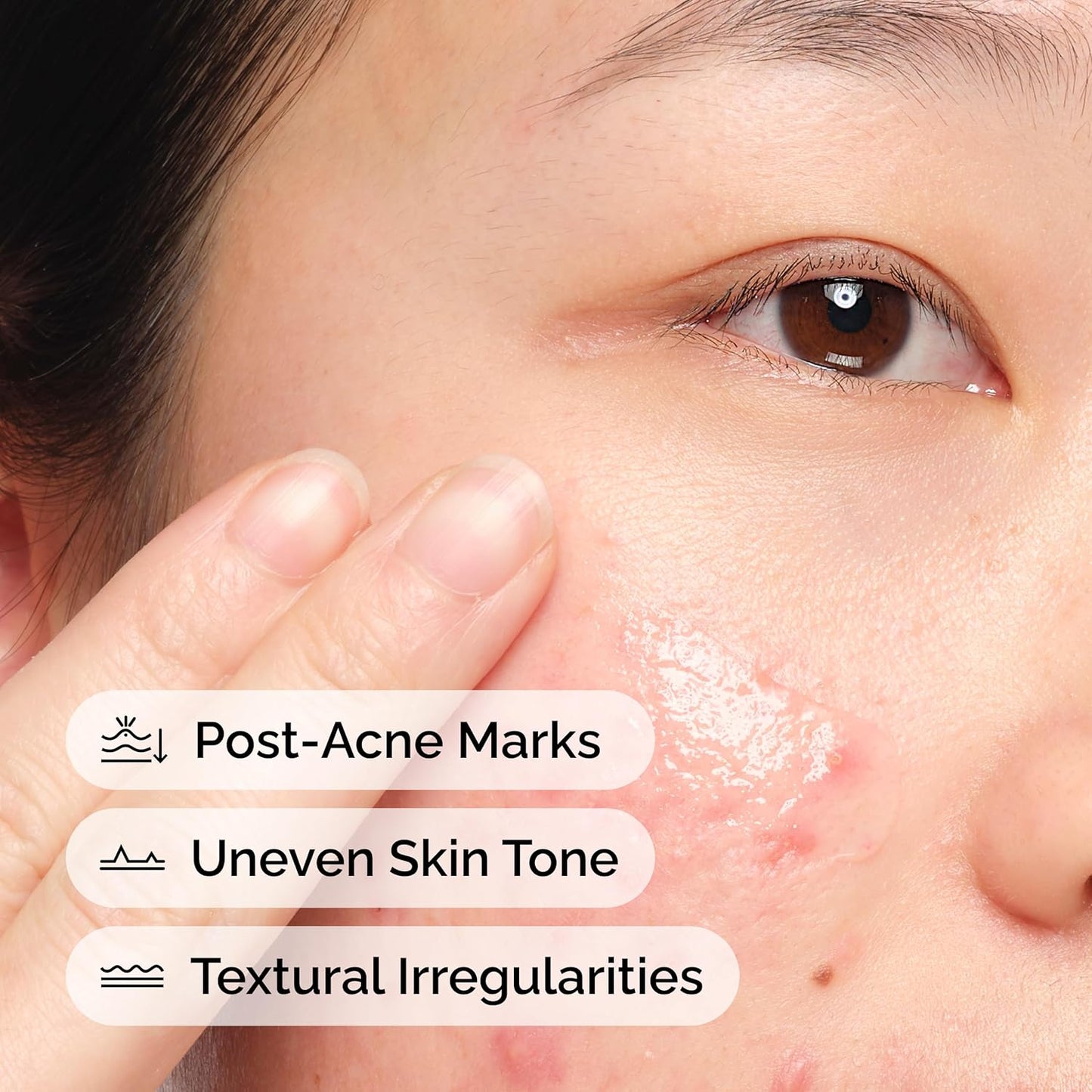 The Ordinary Aloe 2% + NAG 2% Solution, Soothes Skin and Targets Post-Acne Marks, 1 Fl Oz