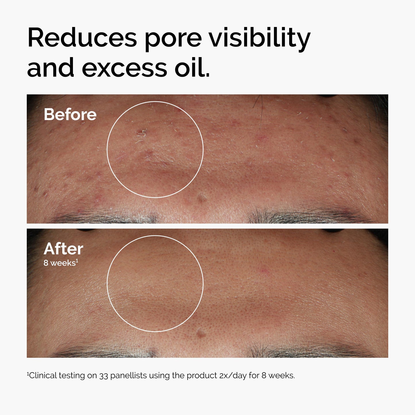 The Ordinary Niacinamide 10% + Zinc 1%, Smoothing Serum for Blemish-Prone Skin